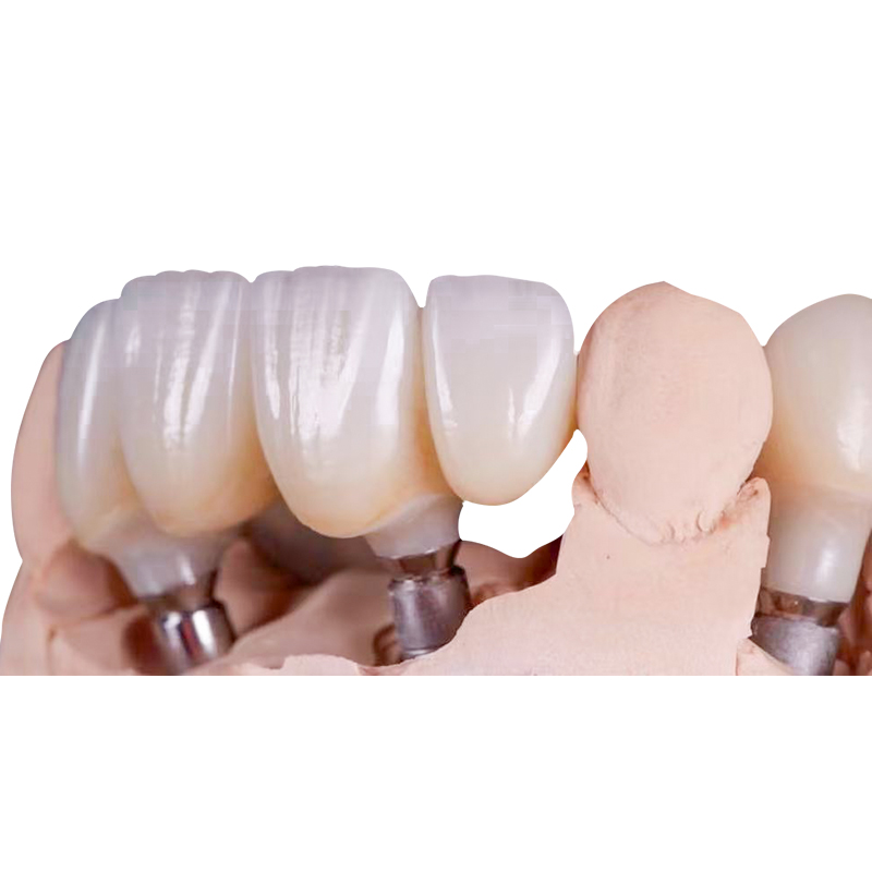 Implant Crown vs. Traditional Crown: Key Differences