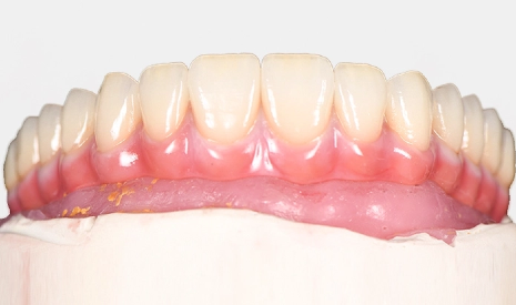 Are You A Candidate for A Fixed Implant Bridge?