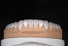 Porcelain Laminate Veneer