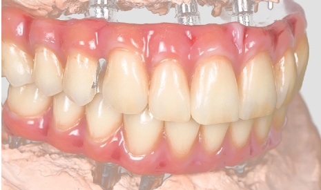 What Is An Implant-Supported Bridge? A Complete Guide