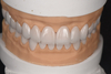 Porcelain Laminate Veneer