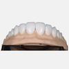 Porcelain Veneers