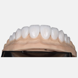 Porcelain Veneers
