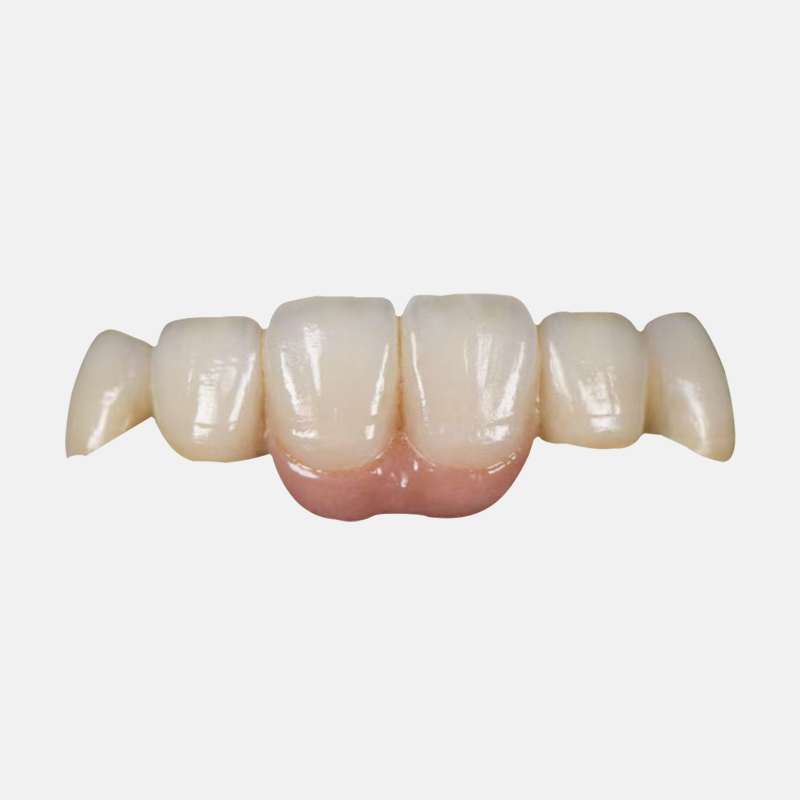 Digital scanning and milling workflow for zirconia bridge