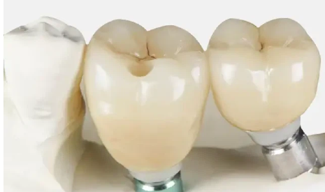 How Many Implants Are Needed for A Dental Bridge?