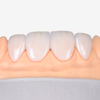 Porcelain Veneers