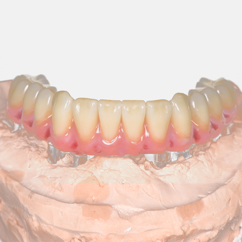 How Long Does an Implant-Supported Crown Last?