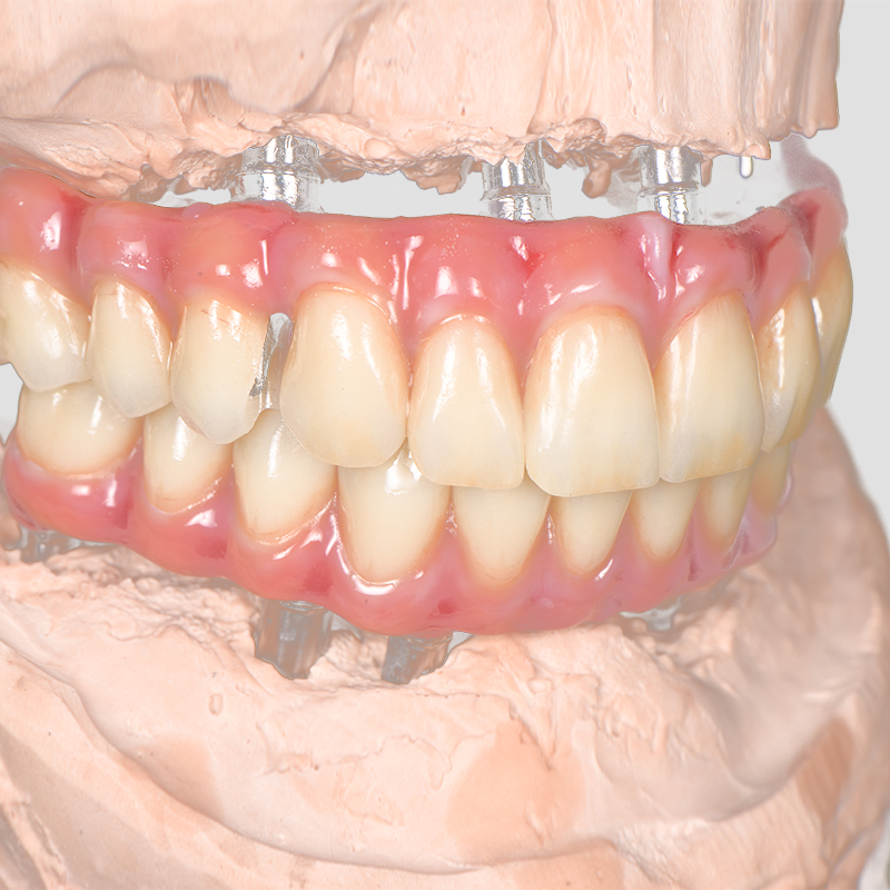 The Step-by-Step Implant Crown Procedure Explained