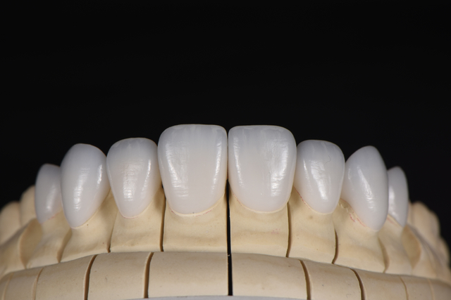 Glass Ceramic Veneer