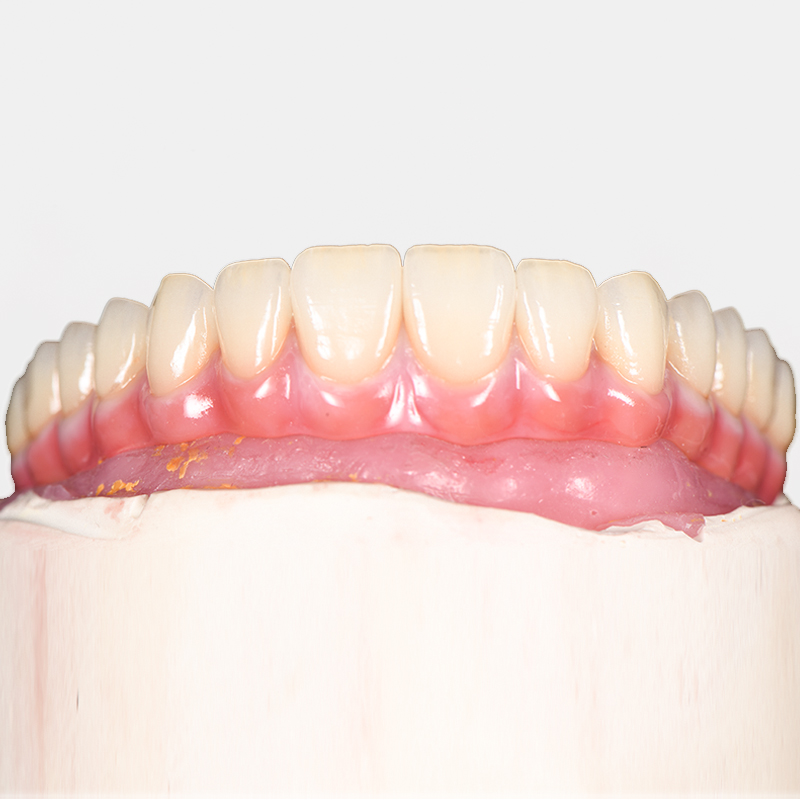 Benefits of Choosing a Crown on a Dental Implant