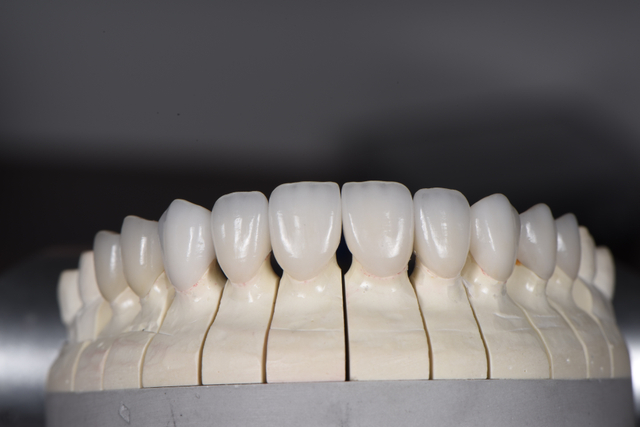 Porcelain Veneers