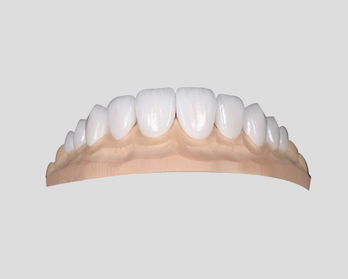 porcelain veneers
