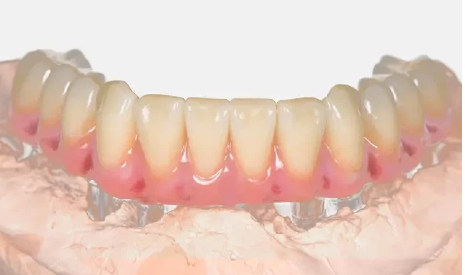 Cost And Benefits of An Implant-Supported Bridge