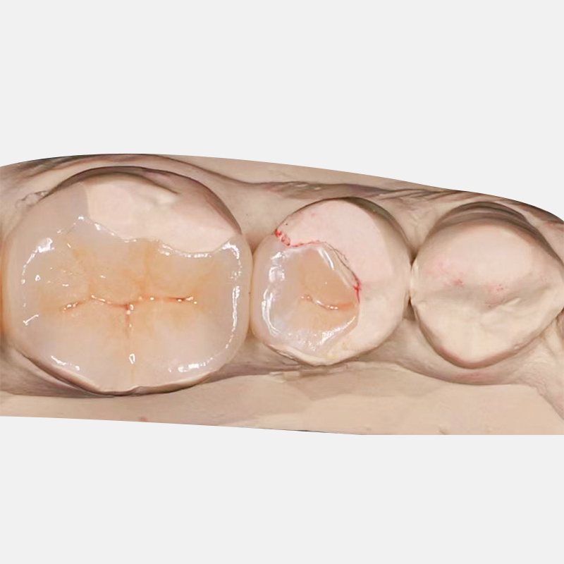 Ceramic Inlay Onlay Preparation