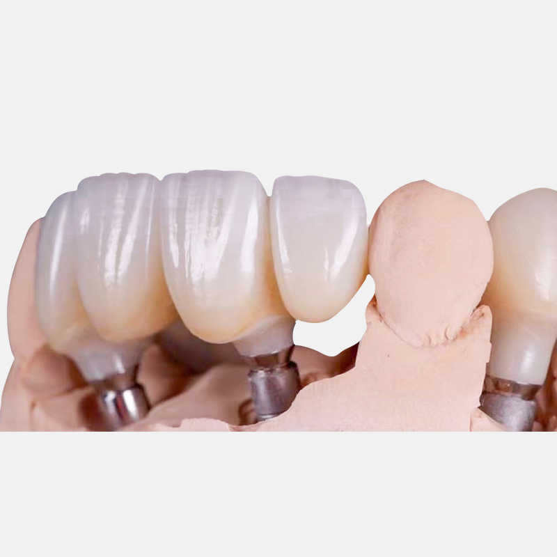 What Occlusal Clearance Is Needed for an Implant Crown?