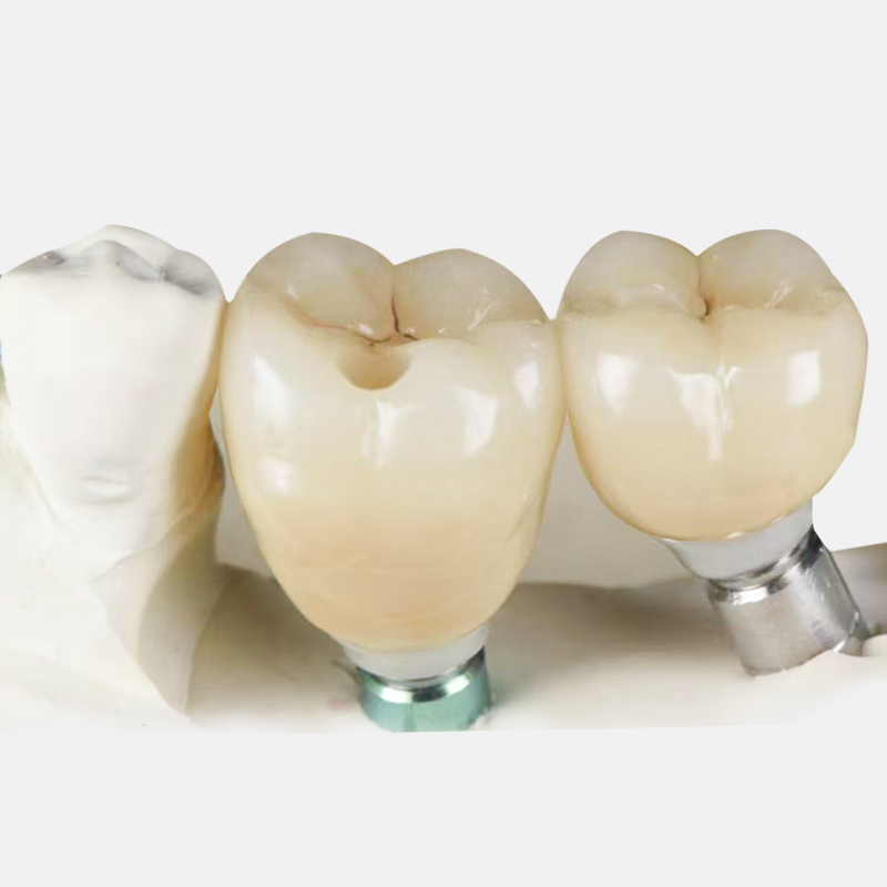 What Occlusal Clearance Is Needed for an Implant Crown?