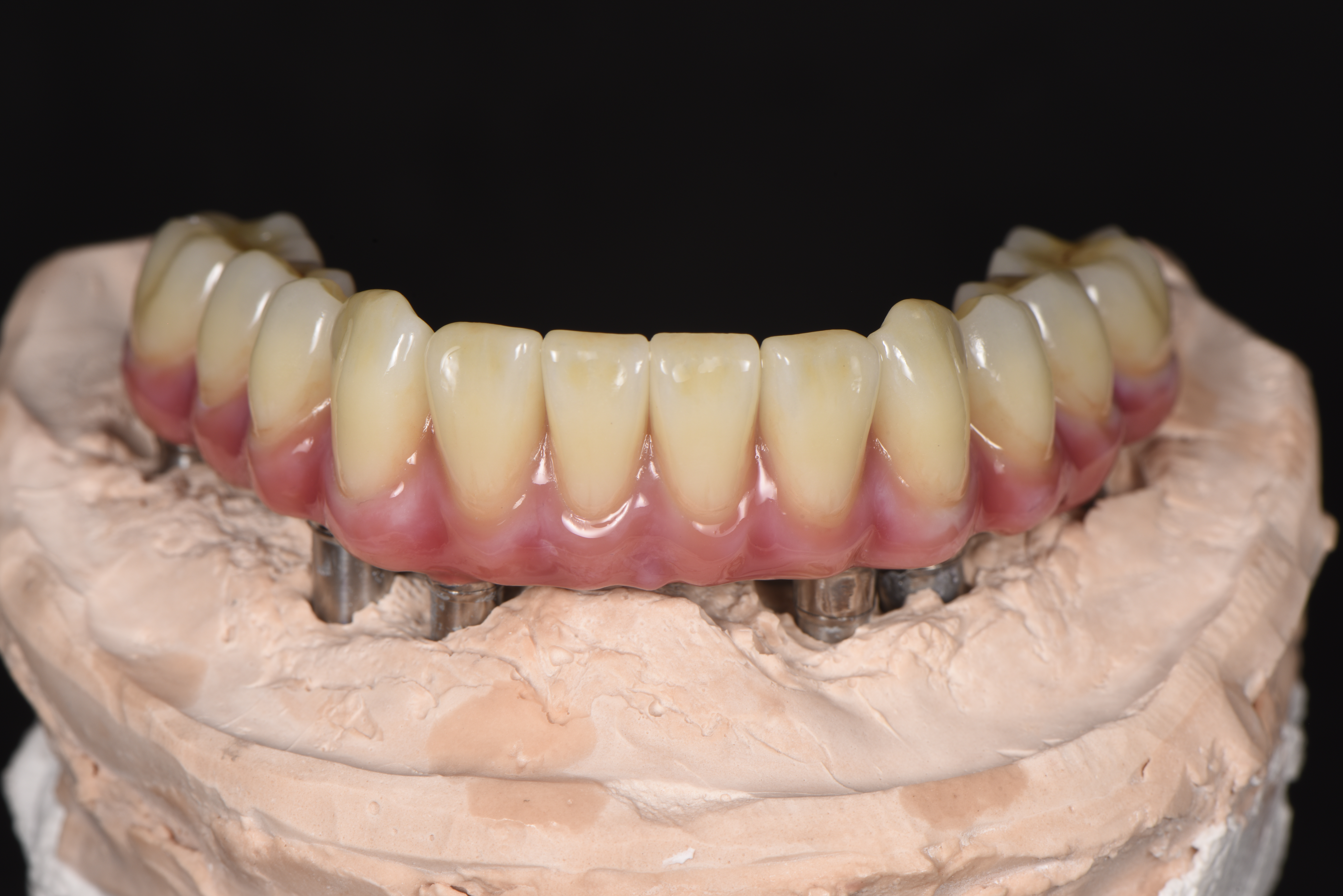 Malo Bridge Occlusal Contacts