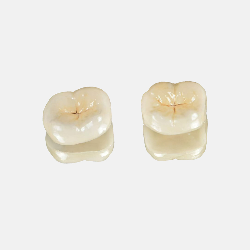 How Does Ceramic Thickness Affect Inlay and Onlay Design?