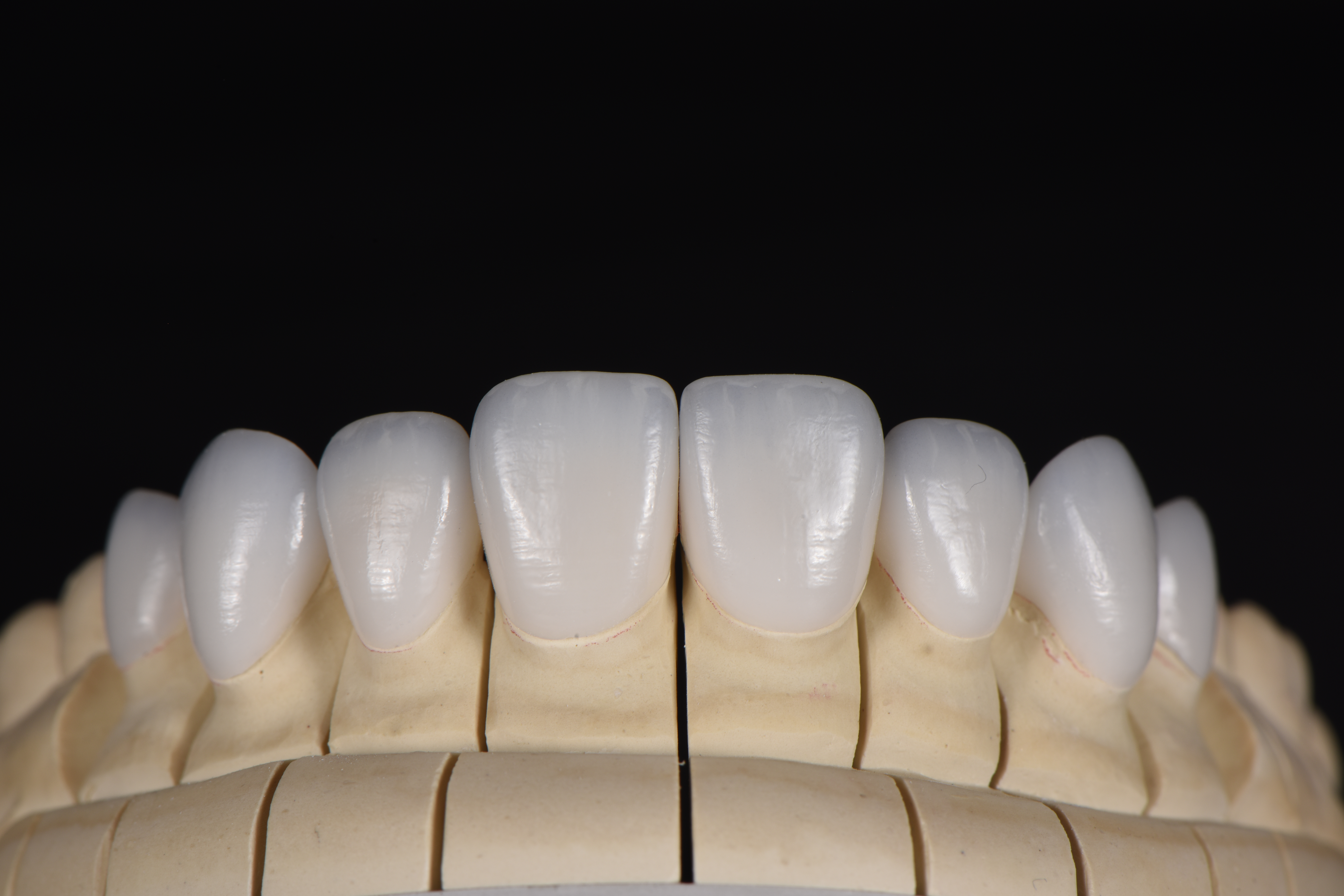 Glass Ceramic Veneers Clinical Application